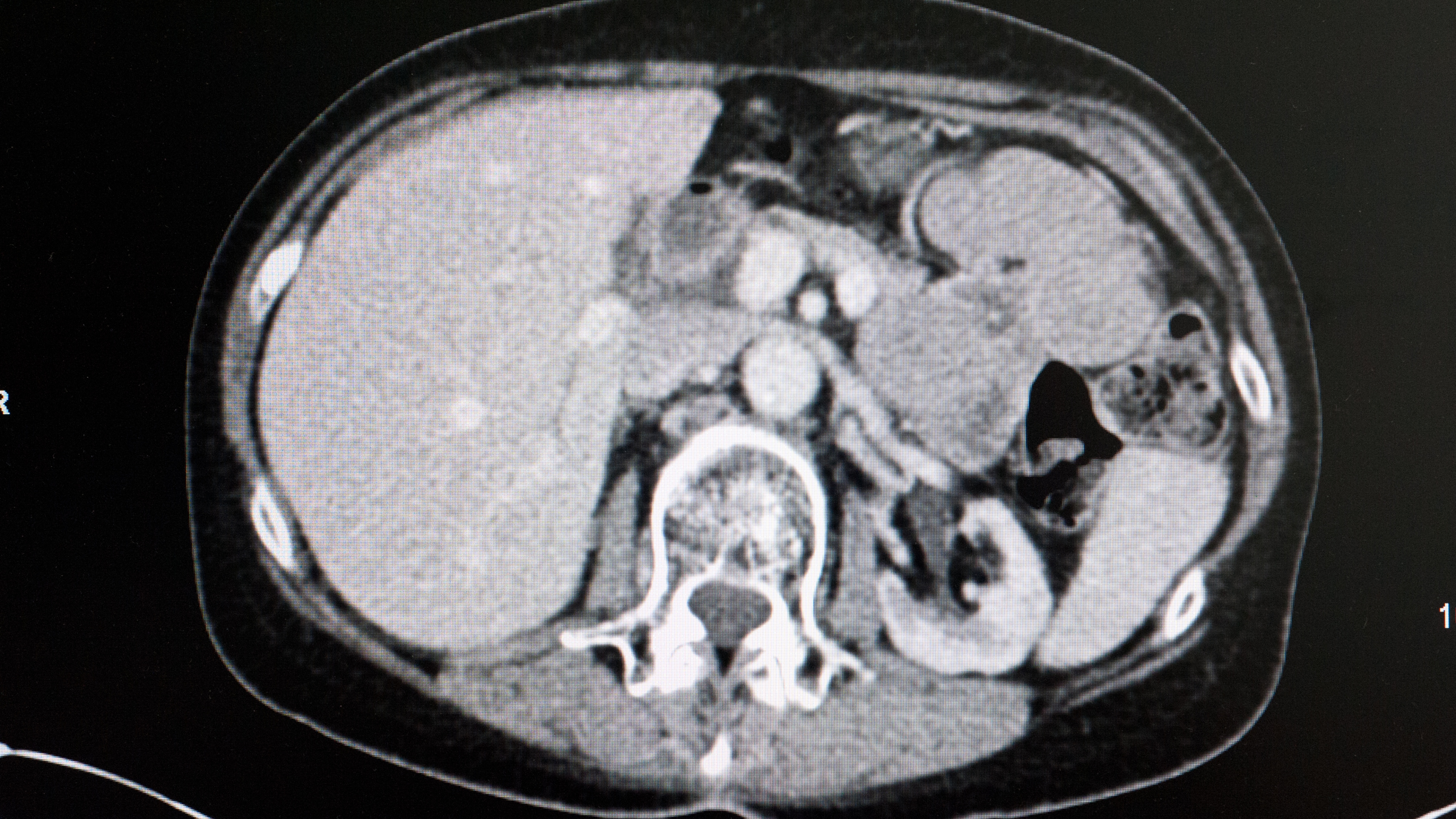 CT scan CT scan of the human body