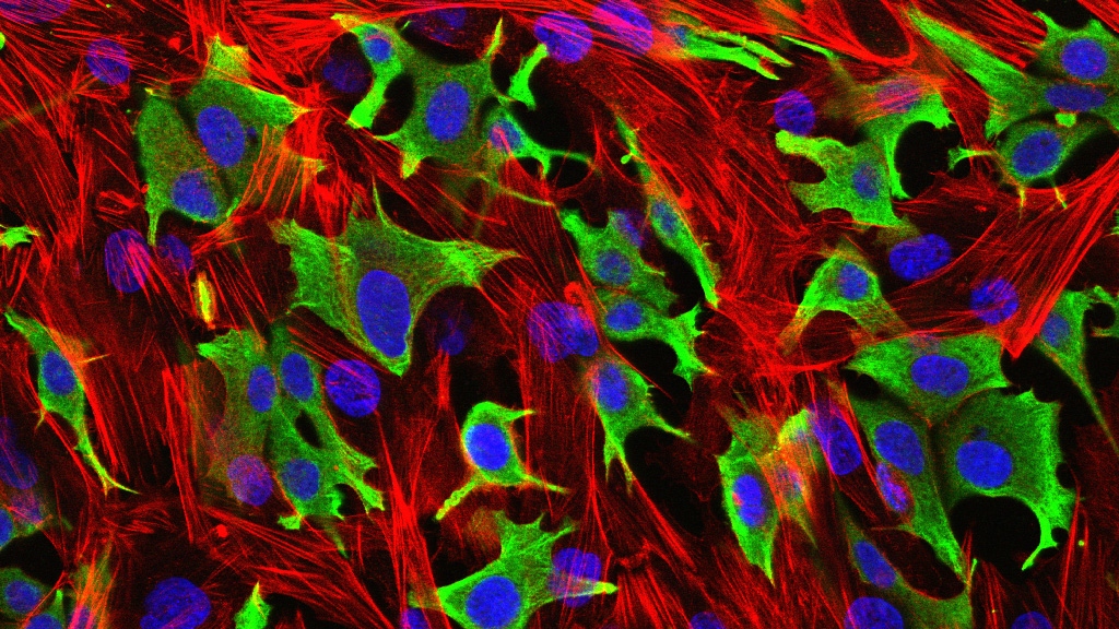 breast cancer cells Breast cancer cells (stained with anti-cytokeratin - green) invading through a layer of fibroblasts (stained for actin - red). Nuclei were counterstained with DAPI - blue