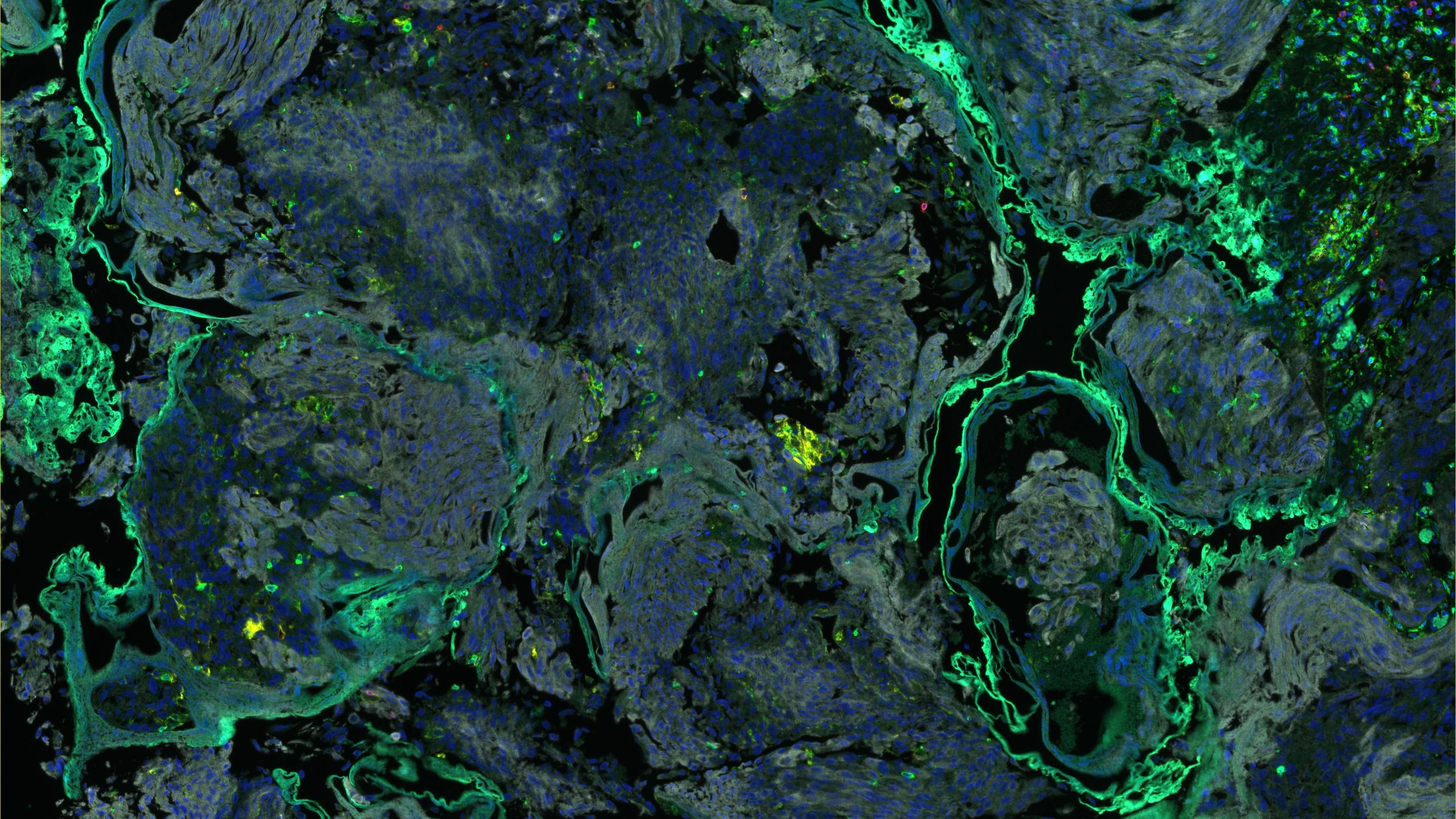 Image of immunofluorescence staining of bladder tumour tissue. Some areas appear lighter green, some dark blue, and others black.