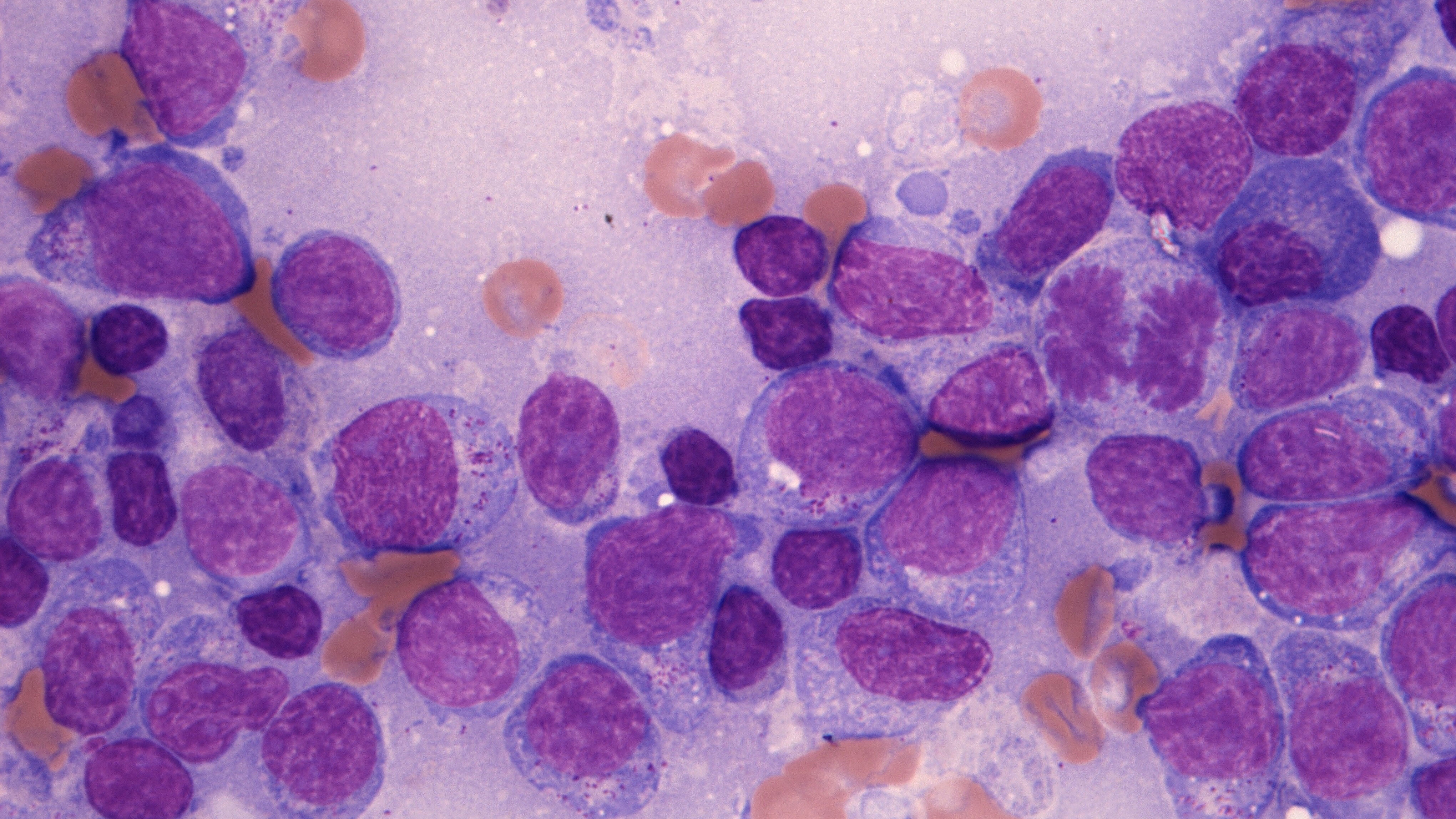NK T-cell lymphoma Image of NK T cell lymphoma - stained purple