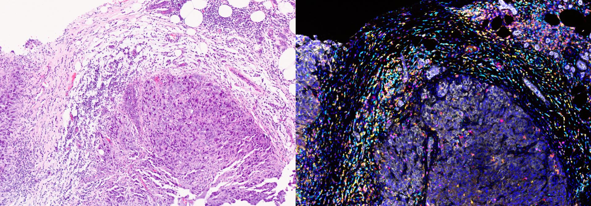 Tumour-infiltrating lymphocytes