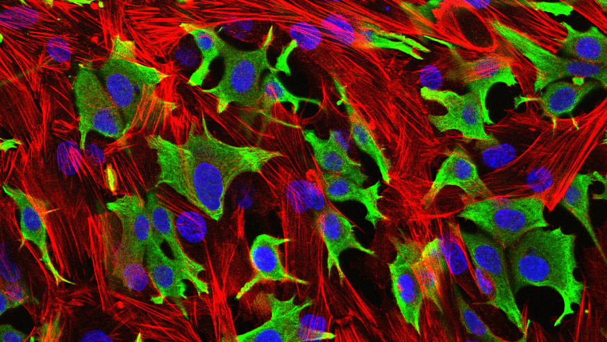 Breast cancer cells (green) invading through a layer of fibroblasts (red). (Luke Henry / the ICR, 2009)