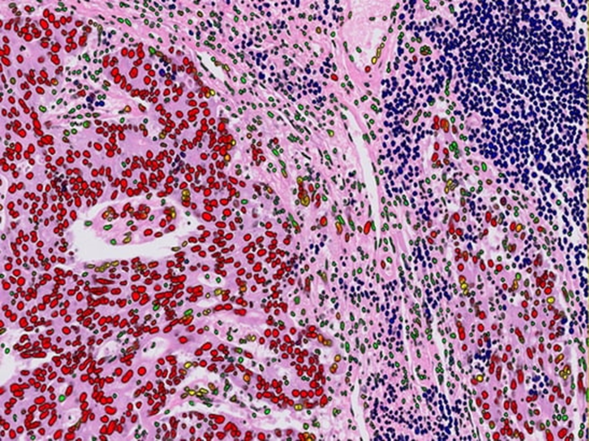 A cancer sample pathology slide with computerised data points. Credit: ICR/Royal Marsden IPU.