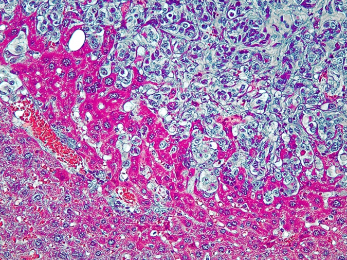 Liver Metastasis in Kaposi Sarcoma Mouse Model by Anthony B. Eason