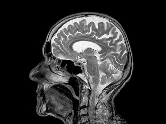 MRI brain scan