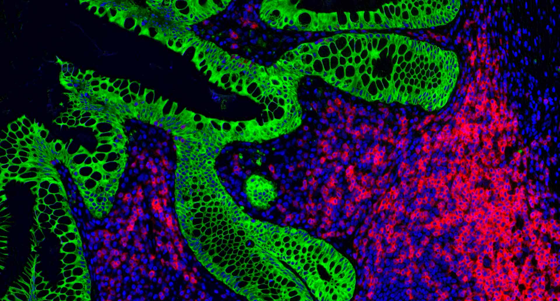 Stained microscope image of CD3 T-cells and malignant PanCK cells