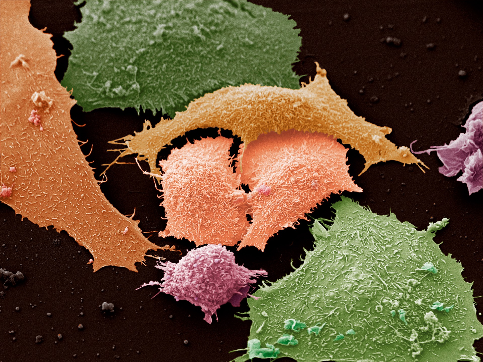 Colour-enhanced image of lung cancer cells growing in culture.