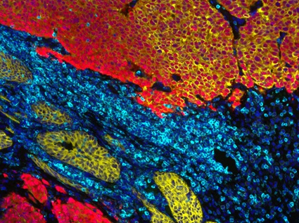 Red, yellow and blue microscope image of immunofluorescence staining showing extension of prostatic adenocarcinoma into the bladder wall