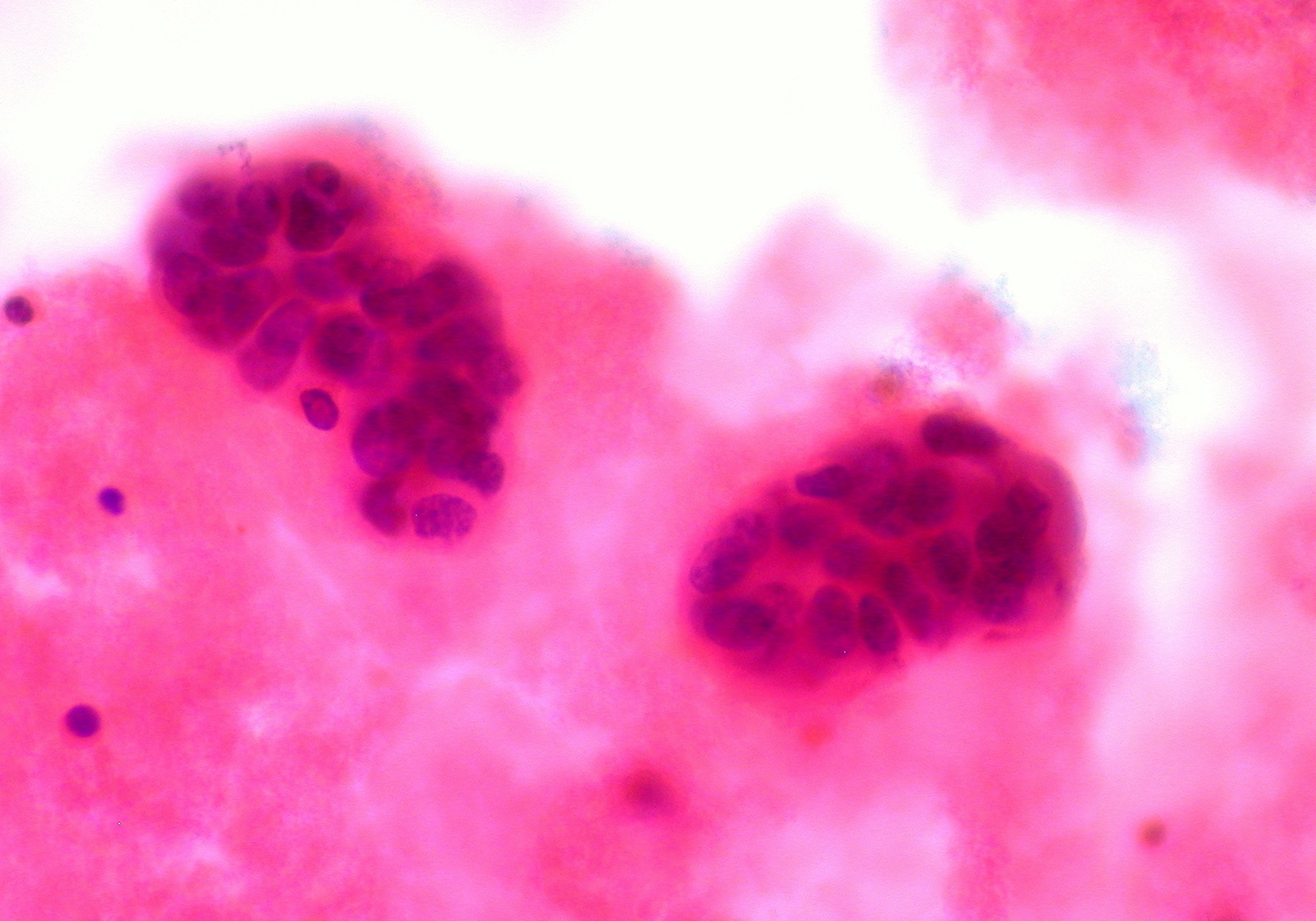 Microscope image of metastatic breast cancer