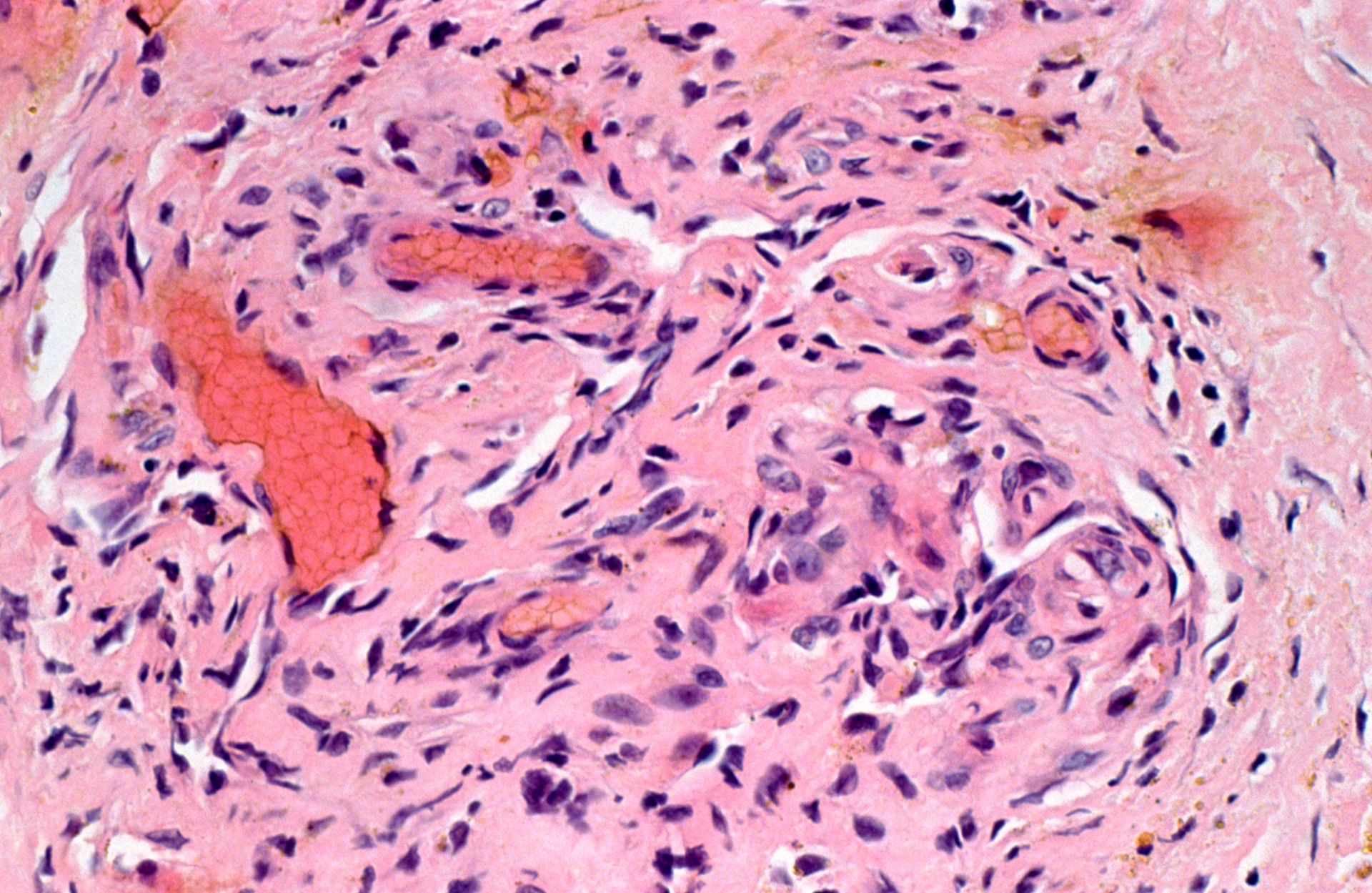 Microscope image of a H&E stain of Kaposi's sarcoma of the skin