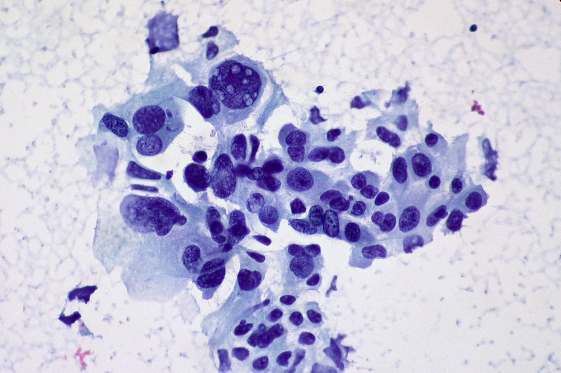 Microscope image of non-small cell lung cancer