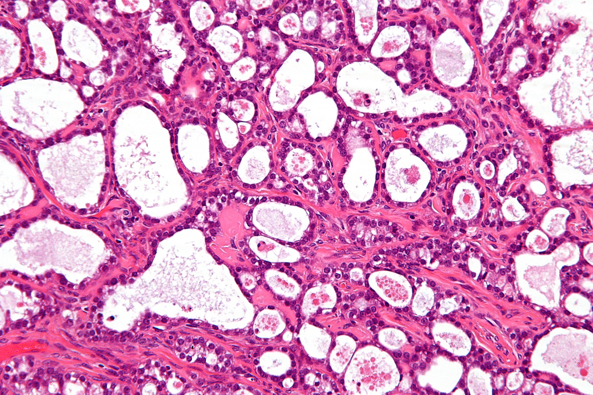 Microscope image of an ovarian clear cell carcinoma