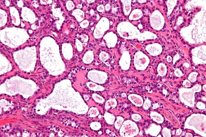 Ovarian clear cell carcinoma Michael Bonert, MD, FRCPC Microscope image of an ovarian clear cell carcinoma