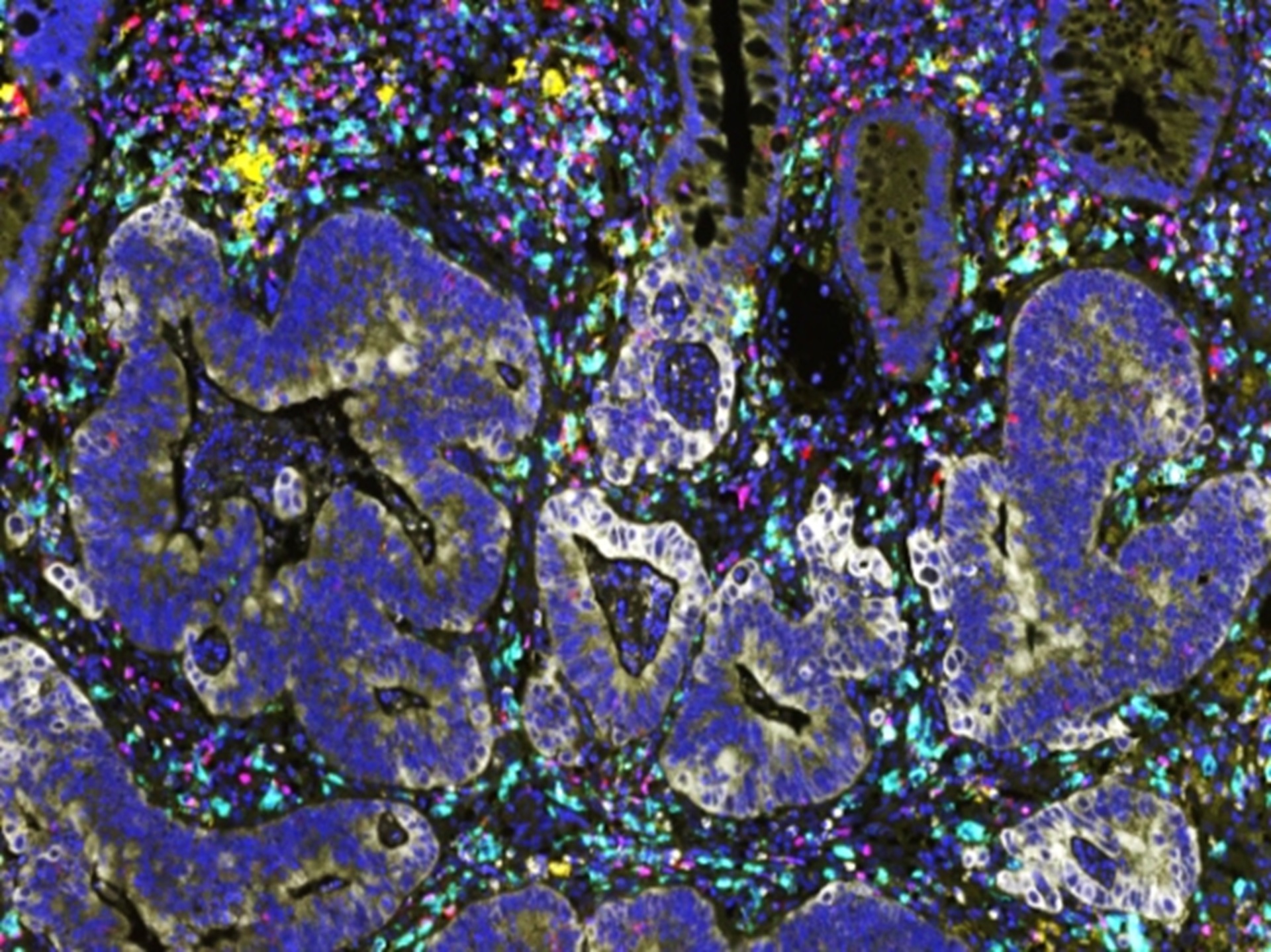 Stained tissue section of a bowel tumour