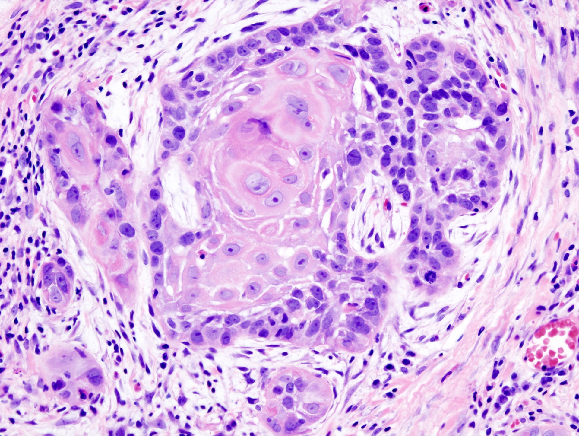 Histopathologic image illustrating squamous cell carcinoma.