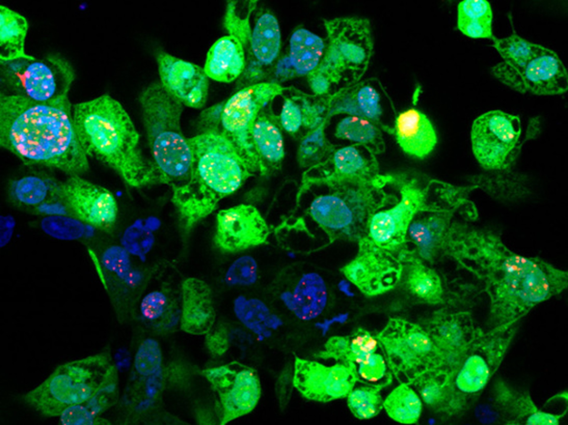 T-vec infected melanoma cells - Kevin Harrington ICR