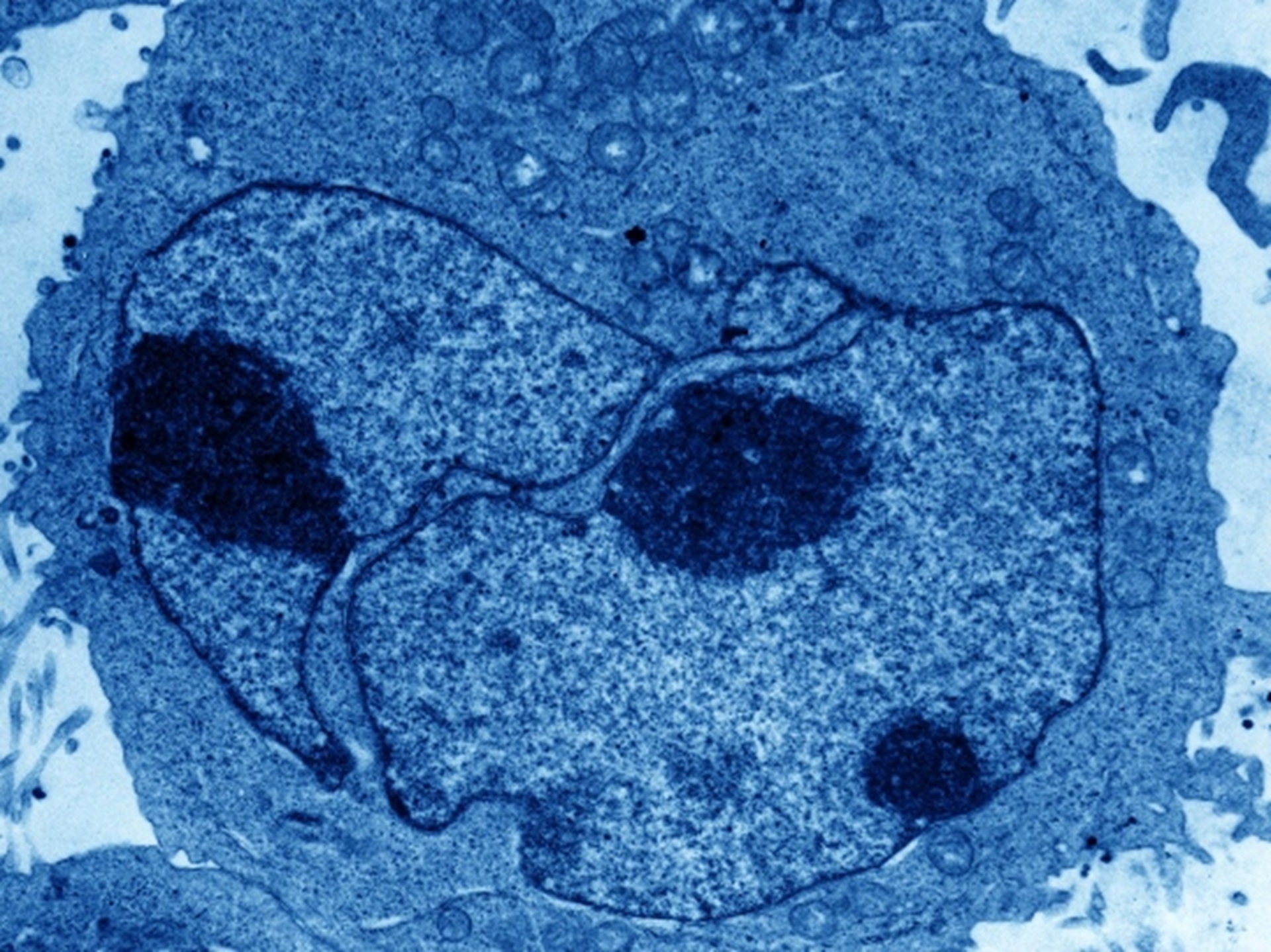 Transmission electron micrograph of a lymphoblast, an abnormal cell occuring in lymphoblastic leukaemia