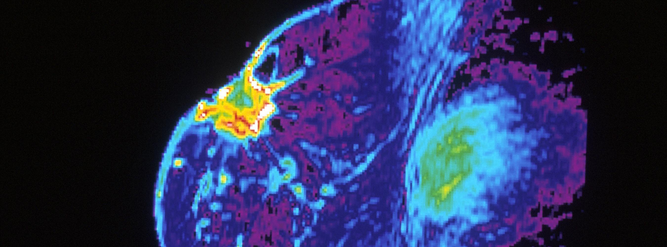 mri-of-breast fb cover MRI scan of a breast tumour