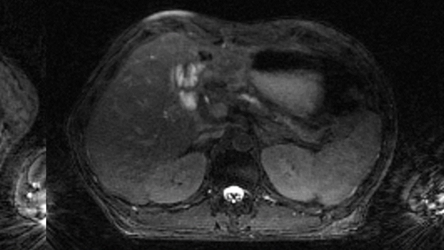 Image of pancreatic adenocarcinoma