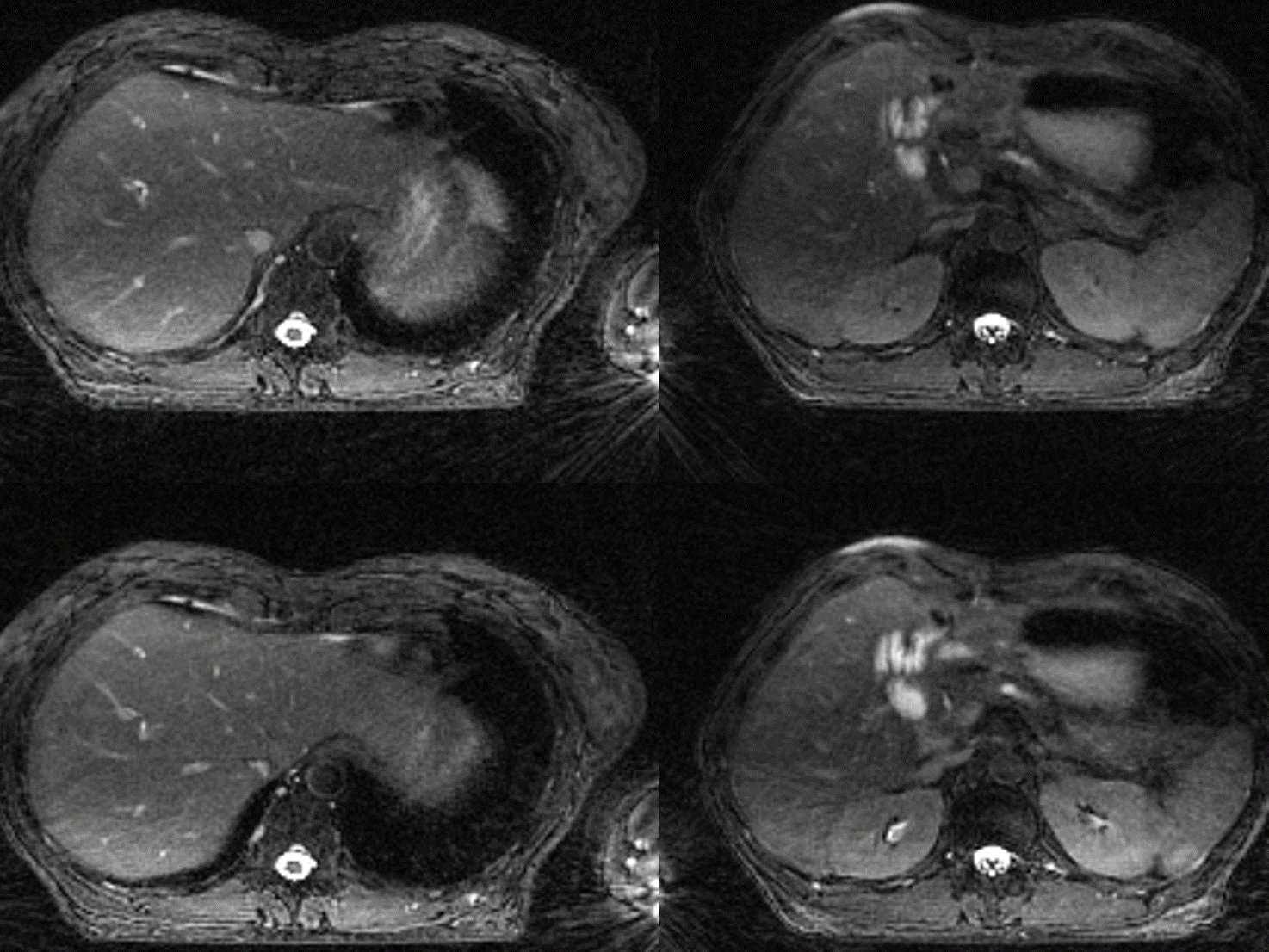 Image of pancreatic adenocarcinoma