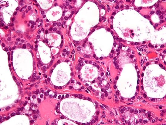 A high magnification image of ovarian clear cell carcinoma