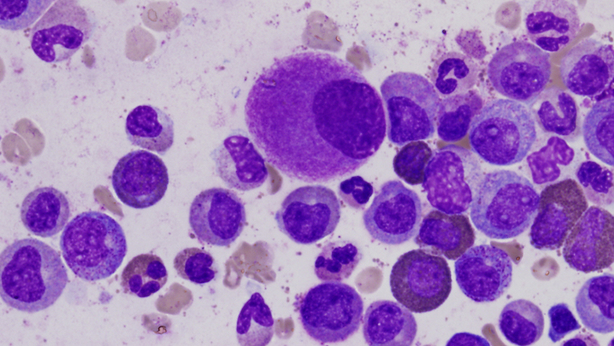 A small, hypolobated megakaryocyte in a bone marrow aspirate, typical of chronic myelogenous leukemia (photo: Difu Wu/CC BY-SA 3.0)