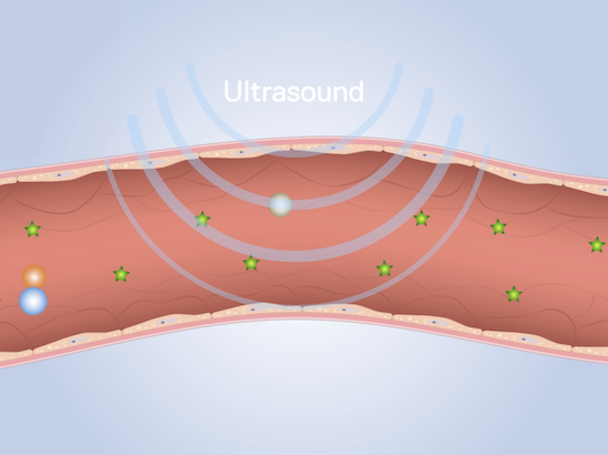 Diagram depicting Acoustic Cluster Therapy being used to activate clusters of microdroplets and microbubbles inside a blood vessel