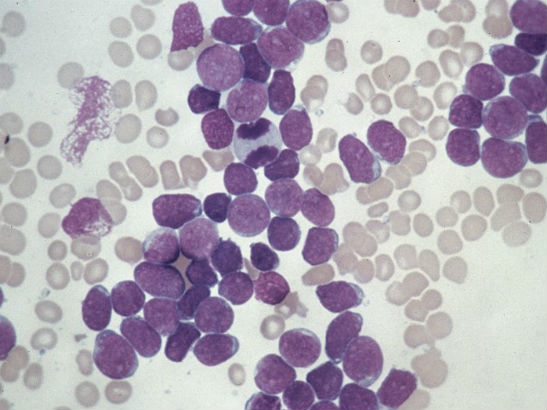 Acute lymphoblastic leukaemia