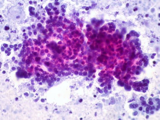 Adenocarcinoma