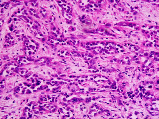 Adenocarcinoma Stomach Cancer Wikipedia