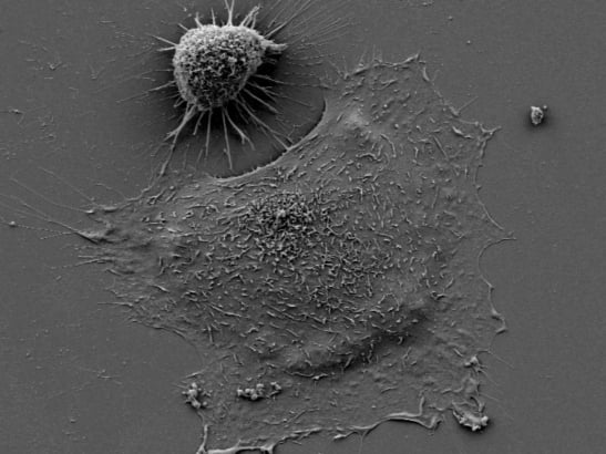 Image shows a small round melanoma cell at the top and a big/flat melanoma cell underneath it