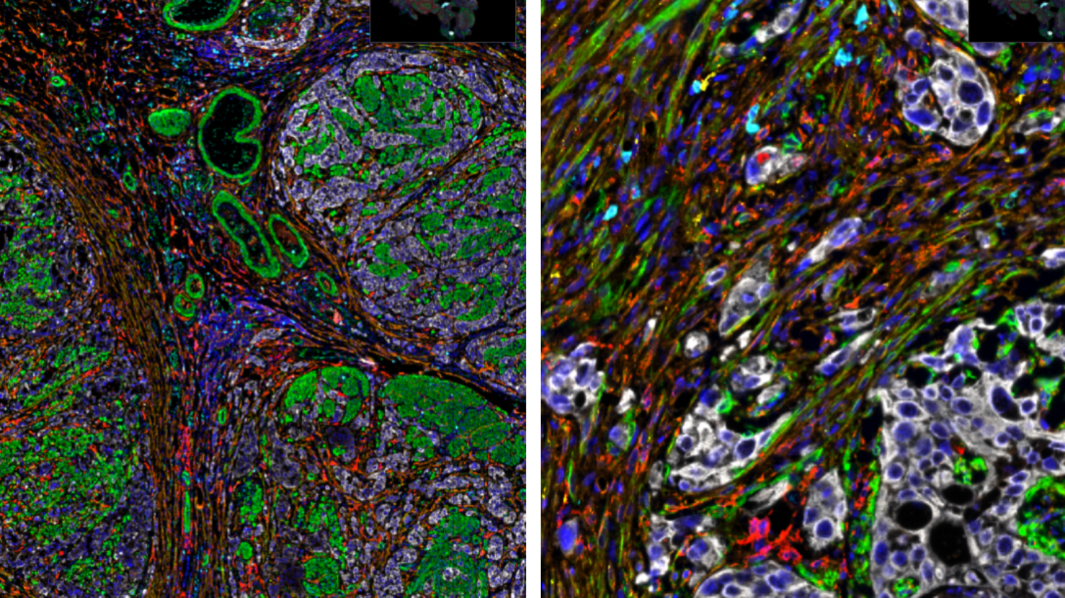 Patient samples of muscle-invasive bladder cancer