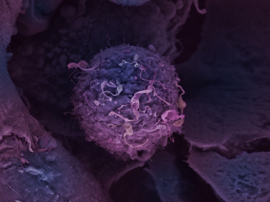 Breast cancer cell 547x410 Breast cancer cell