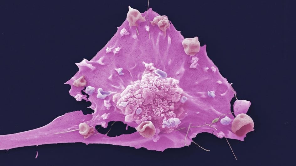 breast cancer cell