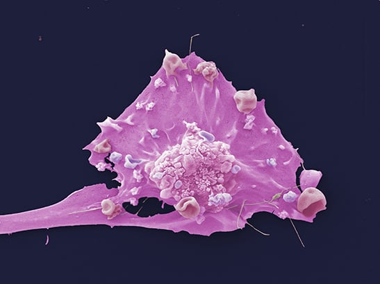 Breast cancer cell from a cultured cell line 547x410 Breast cancer cell from a cultured cell line 547x410