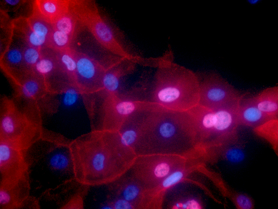 Breast cancer cells Credit Ewa Krawczyk 547x410