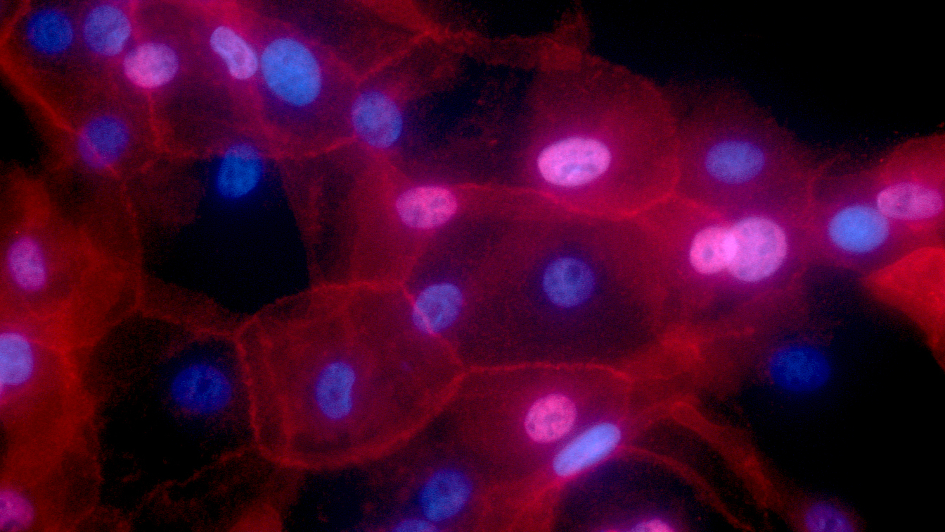 Breast cancer cells Credit Ewa Krawczyk 945x532