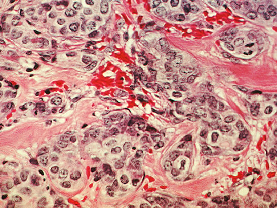 A histological slide of cancerous breast tissue.