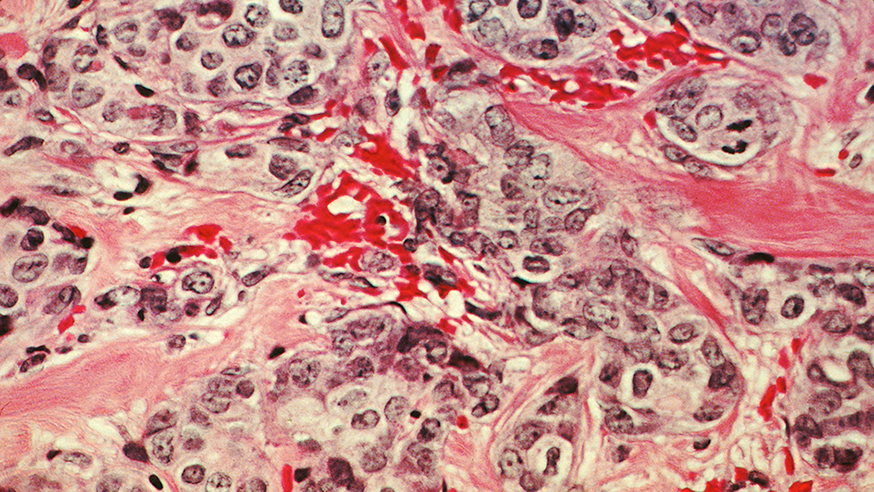 A histological slide of cancerous breast tissue.