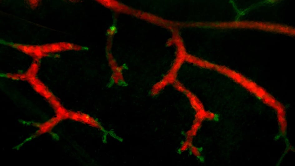 Fluorescence stereograph of a mouse mammary gland, 3 months after it was injected with human breast carcinoma cells