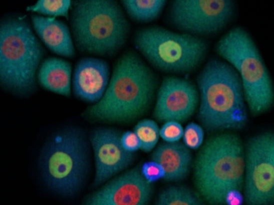 Human breast cancer cells stained for DNA (red)