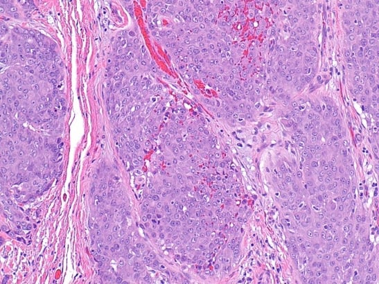 carcinoma of salivary gland