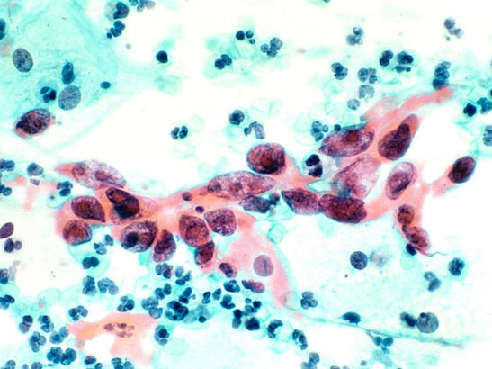 Cytological specimen showing cervical cancer