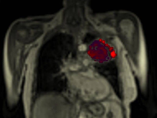 Scan of the chest of a patient with non-small cell lung cancer