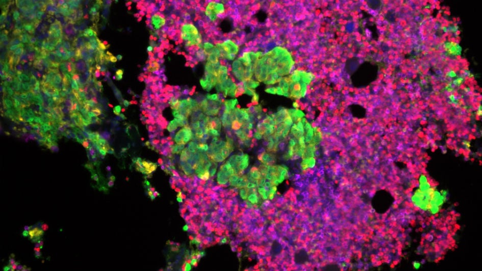 De bono prostate cancer carousel (Mateus Crespo/Prof Johann de Bono, the ICR)