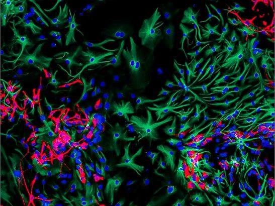 Differentiating brain cancer cells by PhD student Sumana Shrestha