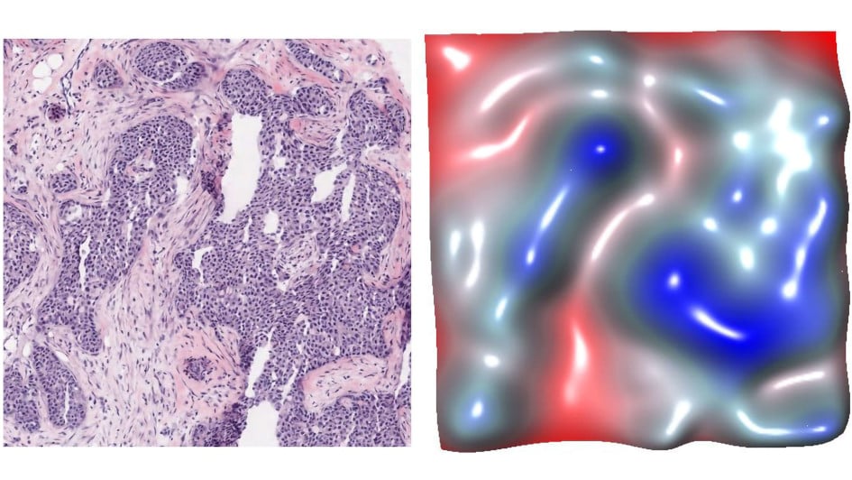 A digitised image of the tumour microenviroment, showing hot spots and cold spots linked to characteristics of the cells, providing a new layer of information about the tumour