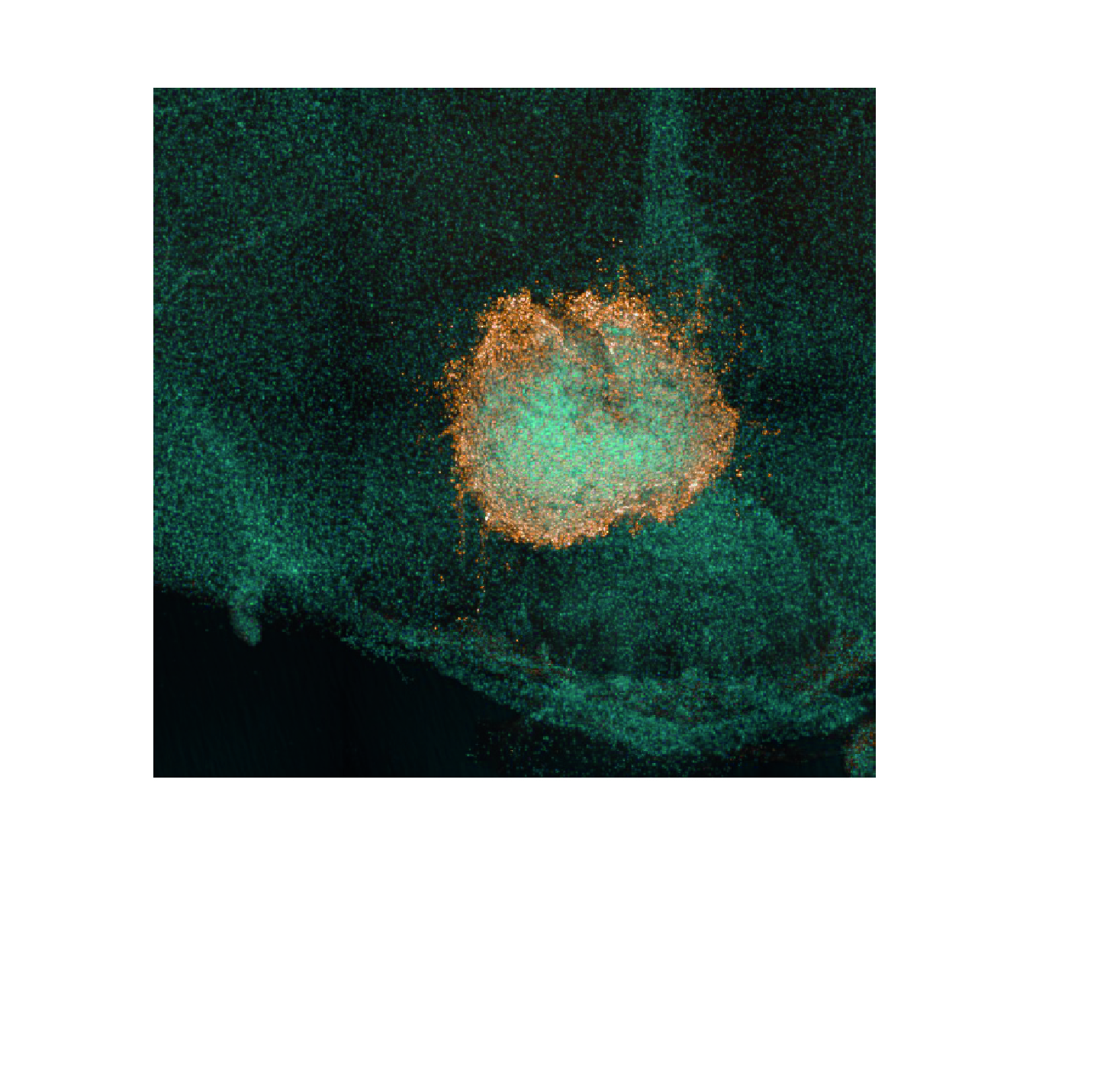 Human DIPG cells (orange) grown on a mouse brain 'slice' (light blue), treated with the drug combination, trametinib and dasatinib and showing cells dying in the middle.