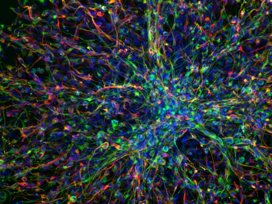 Glioblastoma multiform 3D Matrix - ICR