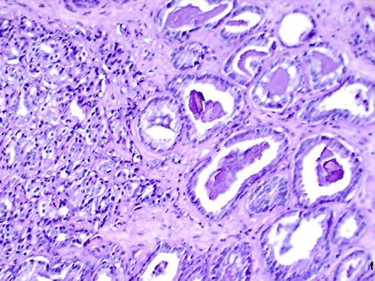 Histological slide showing prostate cancer 4.3 ratio